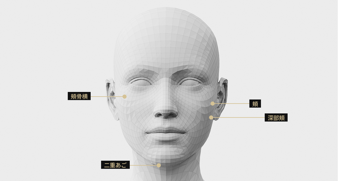 オンダリフティング適用部位を表示した3D顔モデル画像