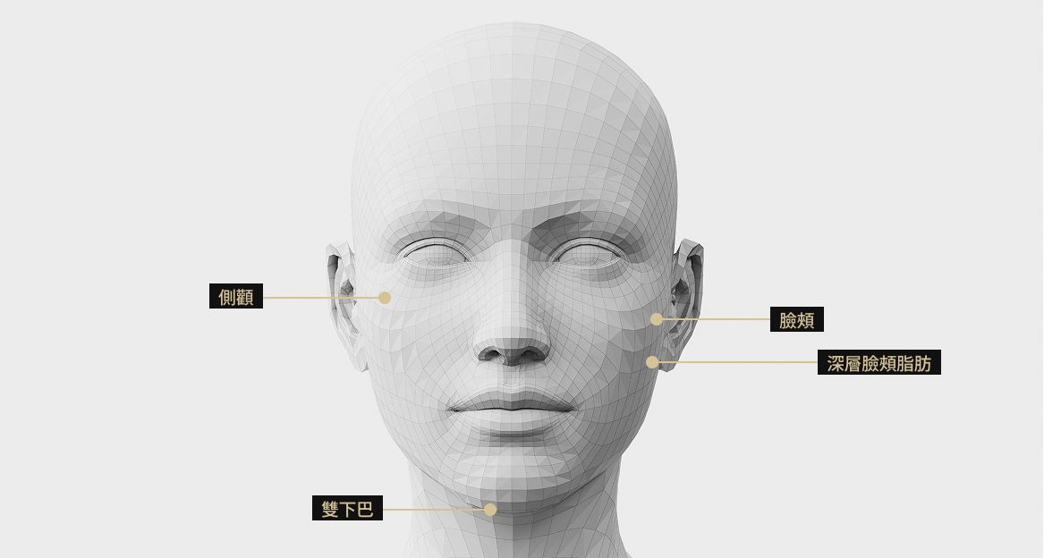 3D臉部模型影像顯示了Onda提拉術的應用區域。