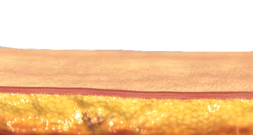 고주파, 전기 자극, 배큠 흡입이 동시에 작용하는 바디 인모드 삼중 에너지 구조 설명 이미지 (시술후)