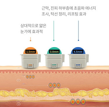 4.5mm·3.0mm·1.5mm 깊이에 초음파 에너지가 전달되는 피부 단면 구조 이미지
