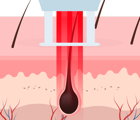 755nm 레이저가 모낭의 멜라닌에 선택적으로 작용하는 클라리티 제모 원리를 시각화한 그래픽 이미지