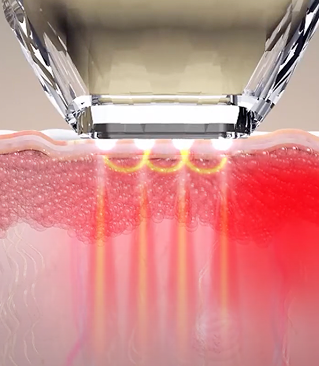 モノポーラとバイポーラの高周波が交差照射されるダイヤモンドチップの作用原理説明画像