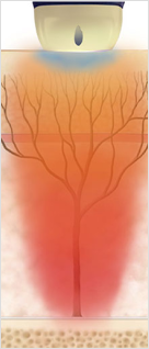 인대층과 심부볼을 자극해 얼굴 윤곽을 또렷하게 만드는 STACK 모드 작용 원리 이미지