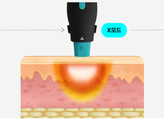6.78MHz 고주파 에너지가 진피층에 열을 전달하는 올리지오X 시술 원리를 시각화한 그래픽 이미지