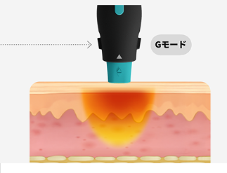 6.78MHz高周波エネルギーが真皮層に熱を伝達するオリジオX手法原理を可視化したグラフィックイメージ