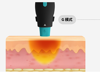 一張圖形圖像形像地展示了 OligioX 治療的原理，其中 6.78MHz 高頻能量將熱量傳遞到真皮層。