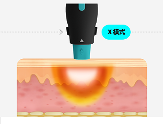 一張圖形圖像形像地展示了 OligioX 治療的原理，其中 6.78MHz 高頻能量將熱量傳遞到真皮層。