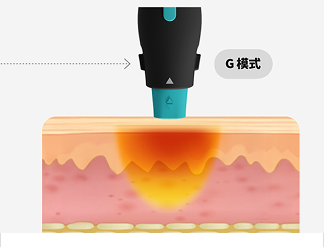 一張圖形圖像形像地展示了 OligioX 治療的原理，其中 6.78MHz 高頻能量將熱量傳遞到真皮層。