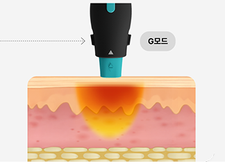 6.78MHz 고주파 에너지가 진피층에 열을 전달하는 올리지오X 시술 원리를 시각화한 그래픽 이미지