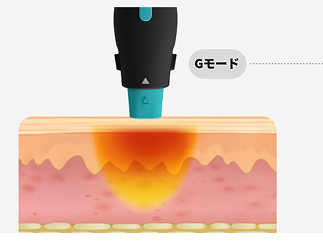 6.78MHz高周波エネルギーが真皮層に熱を伝達するオリジオX手法原理を可視化したグラフィックイメージ
