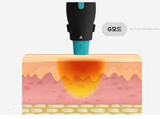 6.78MHz 고주파 에너지가 진피층에 열을 전달하는 올리지오X 시술 원리를 시각화한 그래픽 이미지