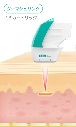 表皮層から真皮層、SMAS層までの超音波エネルギー伝達を示す皮膚構造説明画像
