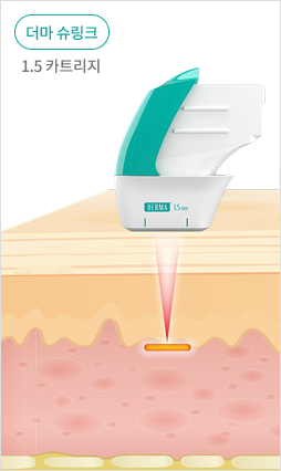 표피층부터 진피층, SMAS층까지 초음파 에너지 전달을 보여주는 피부 구조 설명 이미지