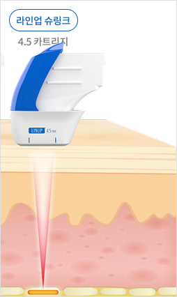 표피층부터 진피층, SMAS층까지 초음파 에너지 전달을 보여주는 피부 구조 설명 이미지