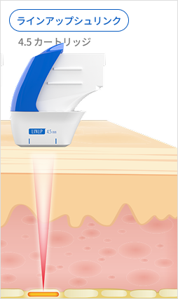 表皮層から真皮層、SMAS層までの超音波エネルギー伝達を示す皮膚構造説明画像