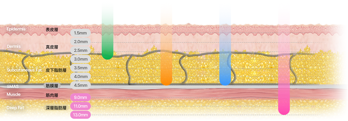 圖示說明了透過調節針頭深度，精確作用於真皮層和SMAS層的線性結構。