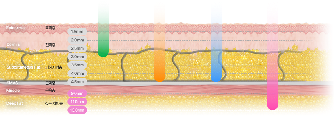 카트리지 깊이 조절로 진피층과 SMAS층을 정밀 타겟팅하는 리니어지 구조 설명 이미지