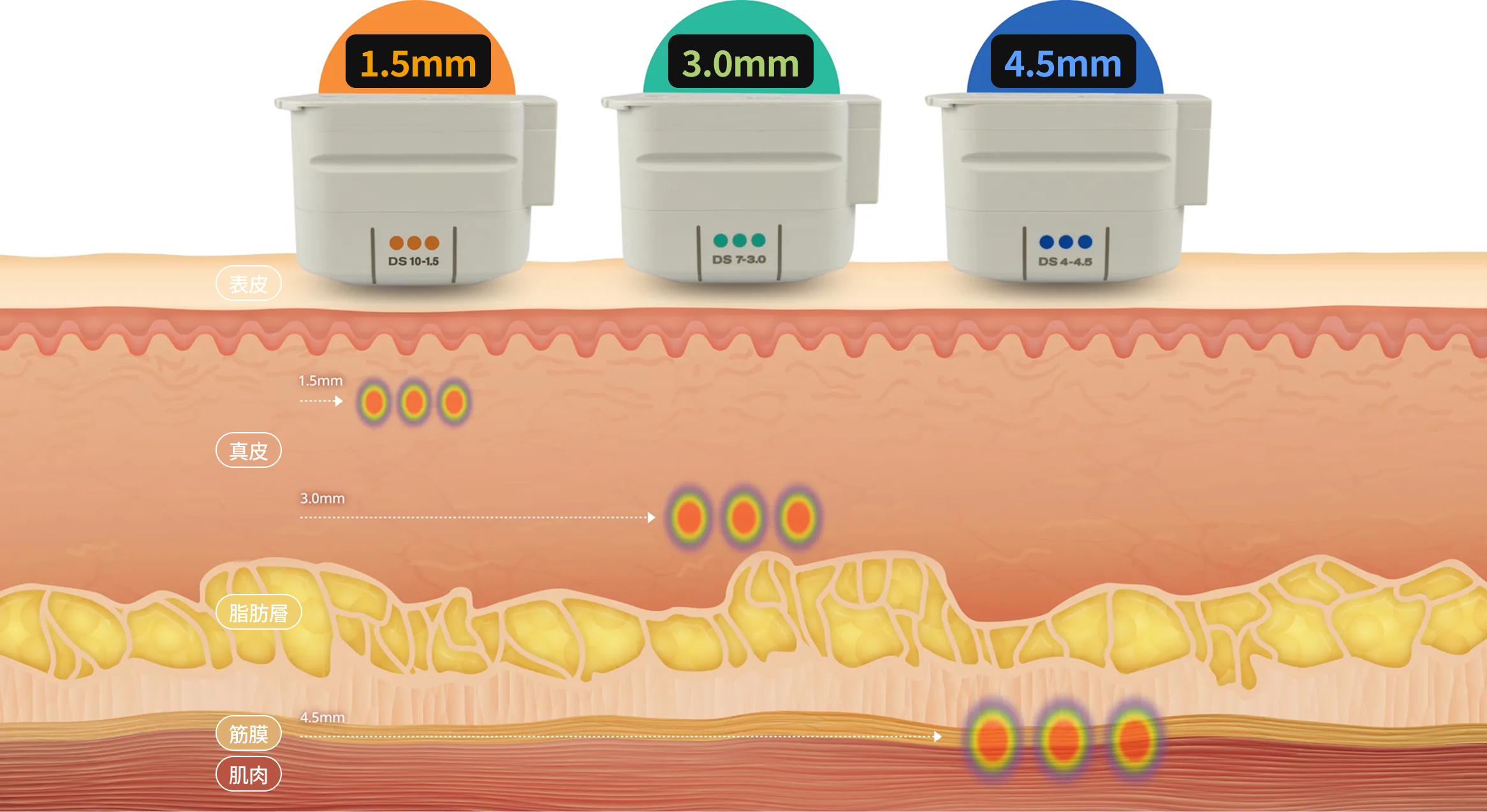 超音波能量在皮膚結構中作用深度分別為 4.5 毫米、3.0 毫米和 1.5 毫米時的橫斷面影像。