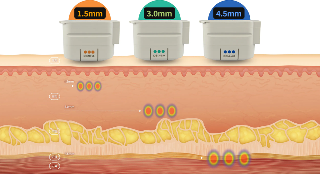 4.5mm·3.0mm·1.5mm 깊이에 초음파 에너지가 전달되는 피부 단면 구조 이미지