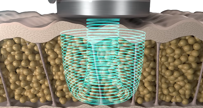 온다 마이크로웨이브 에너지가 피부 내부로 전달되는 장비 이미지