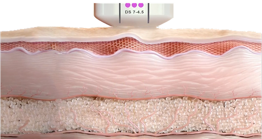 울쎄라 시술 전후 콜라겐 재생에 따른 피부 탄력 및 윤곽선 개선 비교 이미지