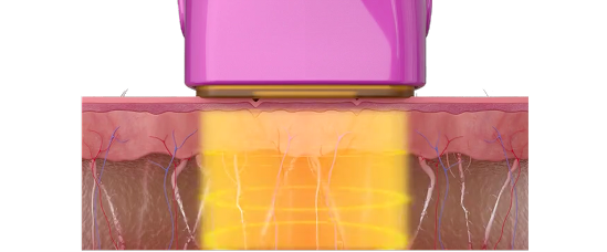 단극성 고주파가 진피층을 깊고 넓게 가열하는 구조를 보여주는 그래픽 이미지