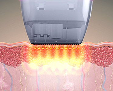 SFA、チップの高周波到達深さを比較して示す非侵襲型チップガイド画像