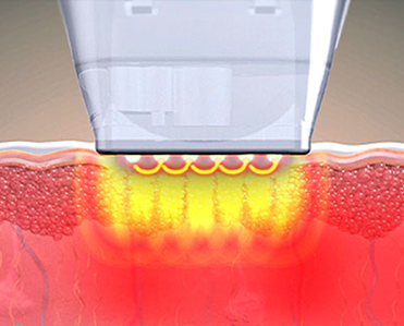 DDRチップの高周波到達深さを比較した非侵襲型チップガイド画像