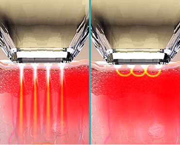 DIAMONDチップの高周波到達深さを比較した非侵襲型チップガイド画像