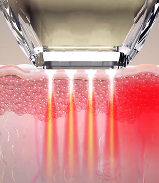 モノポーラ高周波が照射されるダイヤモンドチップの作用原理説明画像