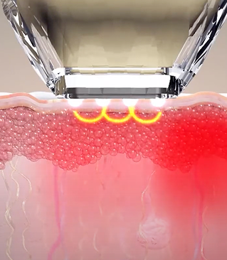 バイポーラ高周波が照射されるダイヤモンドチップの作用原理説明画像