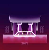 써마지 시술 스텝별 상세 이미지