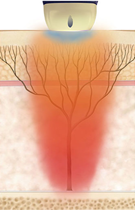인대층과 심부볼을 자극해 얼굴 윤곽을 또렷하게 만드는 STACK 모드 작용 원리 이미지
