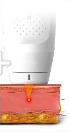 고주파 에너지가 진피층에 열을 전달해 콜라겐 생성을 유도하는 구조 설명 이미지