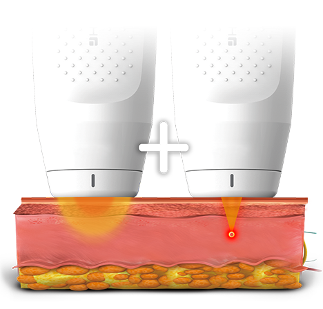 고주파 에너지가 진피층에 열을 전달해 콜라겐 생성을 유도하는 구조 설명 이미지