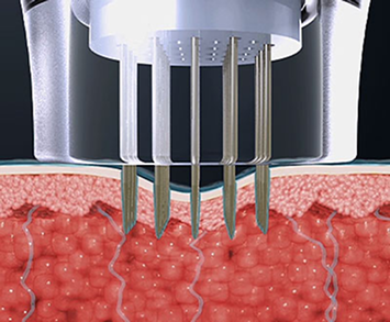 マイクロニードルが皮膚に浸透して高周波エネルギーを伝達する侵襲型施術ステップ説明画像