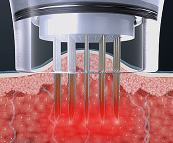 マイクロニードルが皮膚に浸透して高周波エネルギーを伝達する侵襲型施術ステップ説明画像