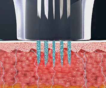マイクロニードルが皮膚に浸透して高周波エネルギーを伝達する侵襲型施術ステップ説明画像