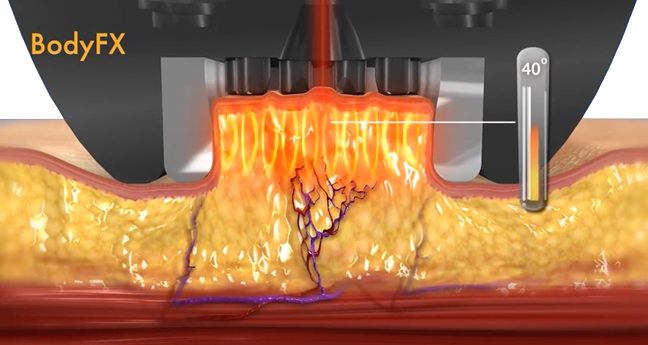 고주파 열에너지와 고전압 전기 자극이 지방세포를 사멸시키는 바디 인모드 시술 원리를 시각화한 그래픽 이미지