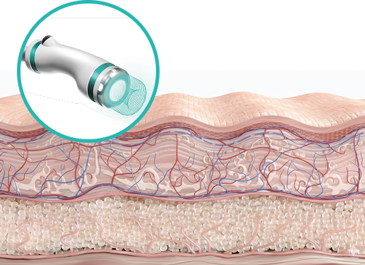 온다리프팅 핸드피스 종류별 시술하는 피부 단면 3D 이미지