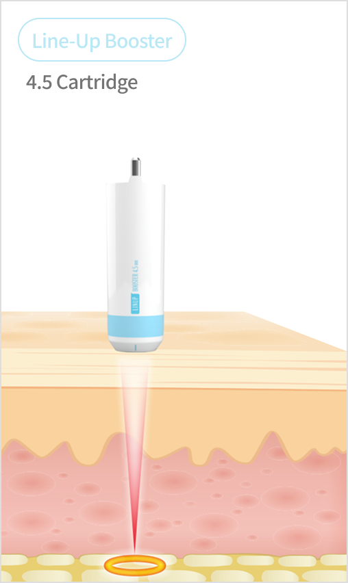 Shrink Universe cartridge guide image comparing various cartridges from 1.5mm to 4.5mm