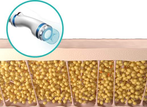 지방층을 깊게 타겟해 바디 슬리밍에 효과적인 7mm 핸드피스 작용 원리 이미지