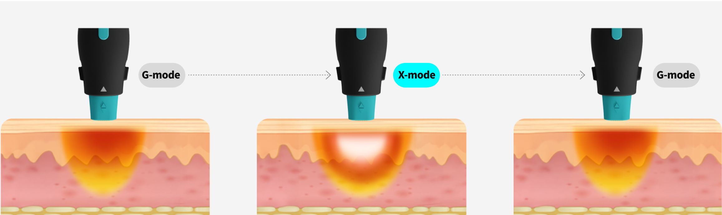 A graphic image visualizing the principle of the OligioX treatment, in which 6.78MHz high-frequency energy delivers heat to the dermis layer.