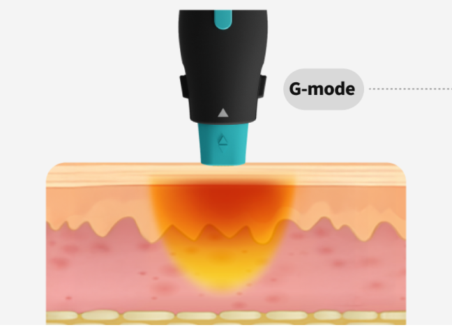 A graphic image visualizing the principle of the OligioX treatment, in which 6.78MHz high-frequency energy delivers heat to the dermis layer.