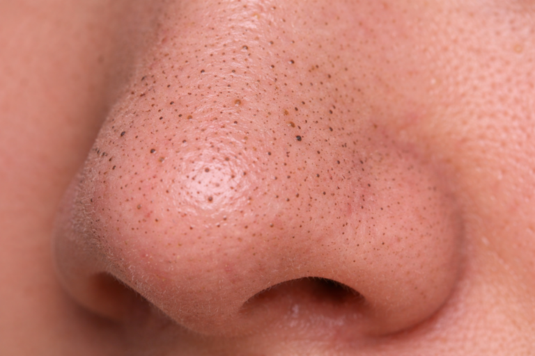 세로로 늘어난 모공, 개선하는 방법은? – 포텐자 & 쥬베룩