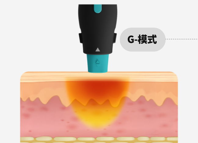 一张图形图像形像地展示了 OligioX 治疗的原理，其中 6.78MHz 高频能量将热量传递到真皮层。