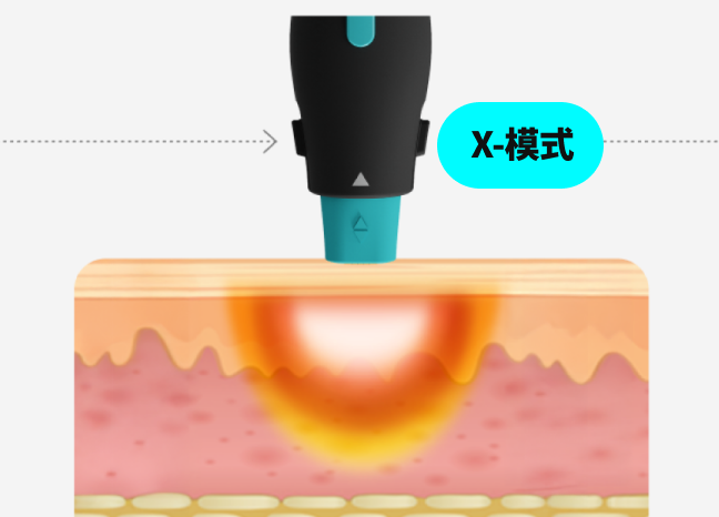 一张图形图像形像地展示了 OligioX 治疗的原理，其中 6.78MHz 高频能量将热量传递到真皮层。