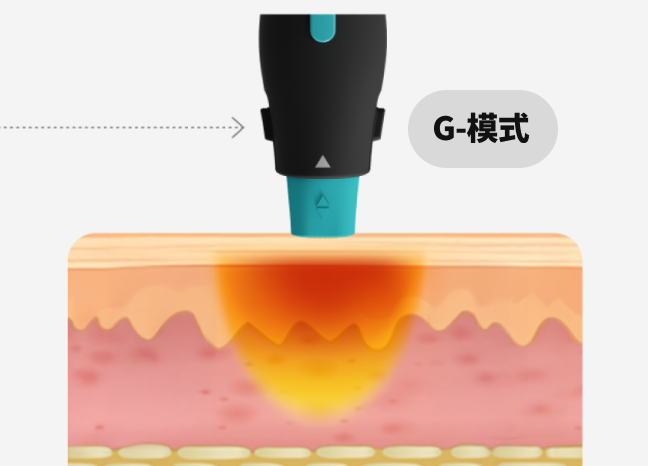 一张图形图像形像地展示了 OligioX 治疗的原理，其中 6.78MHz 高频能量将热量传递到真皮层。